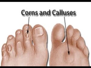 Corns & Calluses