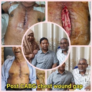 Post CABG chest wound Reconstruction